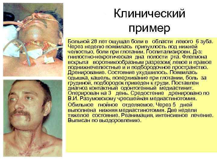 Клинический пример Больной 28 лет ощущал боли в области левого 6 зуба. Через неделю