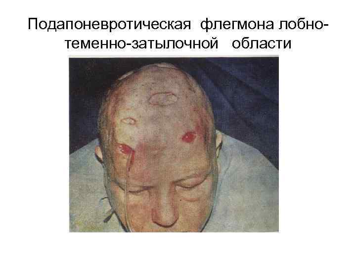 Подапоневротическая флегмона лобнотеменно-затылочной области 