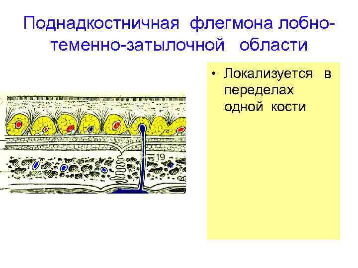 Поднадкостничная флегмона лобнотеменно-затылочной области • Локализуется в переделах одной кости 