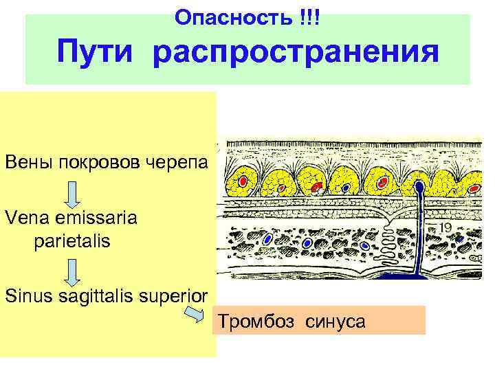 Опасность !!! Пути распространения Вены покровов черепа Vena emissaria parietalis Sinus sagittalis superior Тромбоз