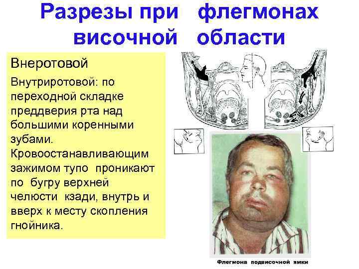 Разрезы при флегмонах височной области Внеротовой Внутриротовой: по переходной складке преддверия рта над большими