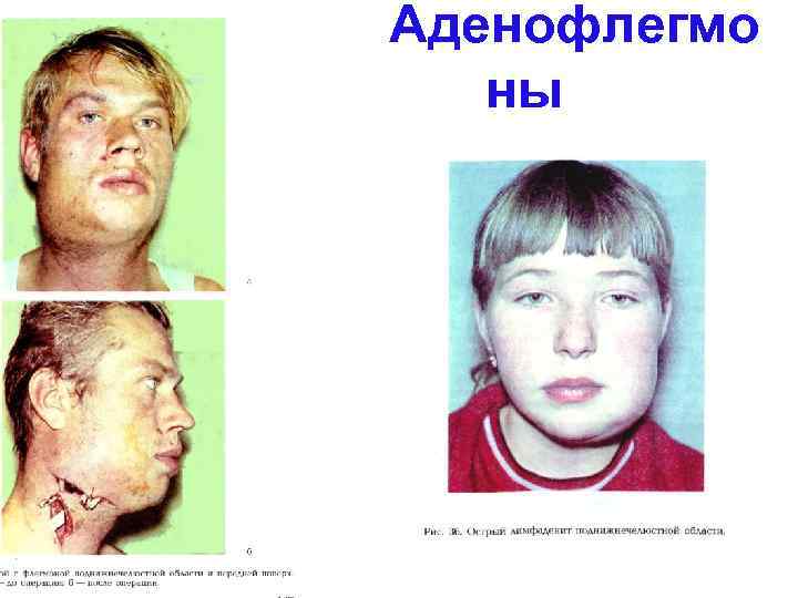 Аденофлегмо ны 