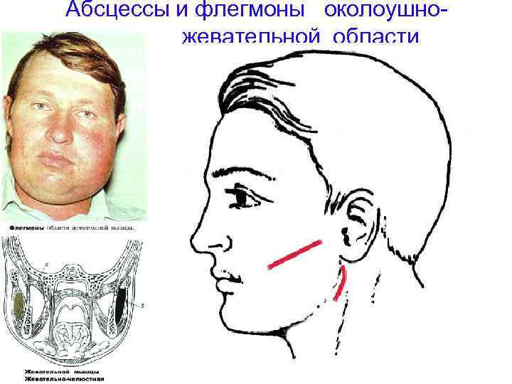 Флегмона полости рта карта вызова