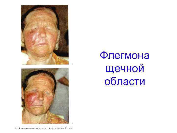Флегмона щечной области 