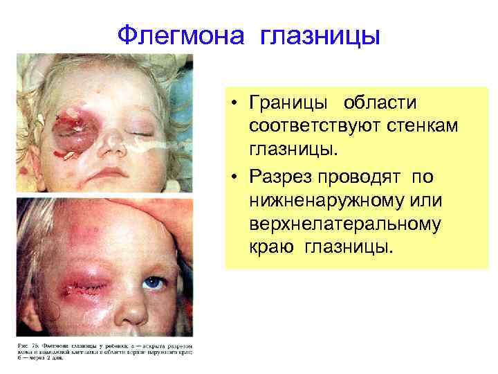 Флегмона глазницы • Границы области соответствуют стенкам глазницы. • Разрез проводят по нижненаружному или