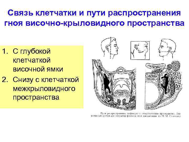 Связь клетчатки и пути распространения гноя височно-крыловидного пространства 1. С глубокой клетчаткой височной ямки