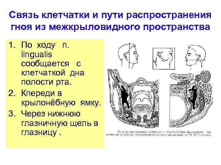 Связь клетчатки и пути распространения гноя из межкрыловидного пространства 1. По ходу n. lingualis