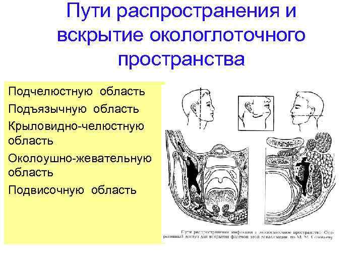 Пути распространения и вскрытие окологлоточного пространства Подчелюстную область Подъязычную область Крыловидно-челюстную область Околоушно-жевательную область