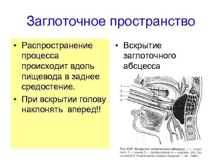 Заглоточное пространство • Распространение процесса происходит вдоль пищевода в заднее средостение. • При вскрытии