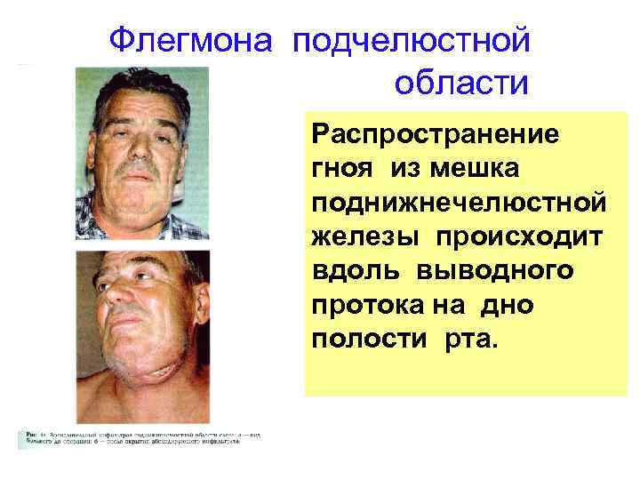 Флегмона подчелюстной области Распространение гноя из мешка поднижнечелюстной железы происходит вдоль выводного протока на