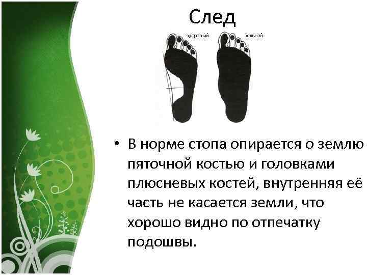 След • В норме стопа опирается о землю пяточной костью и головками плюсневых костей,