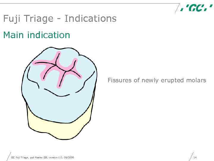 Fuji Triage - Indications Main indication Fissures of newly erupted molars GC Fuji Triage,