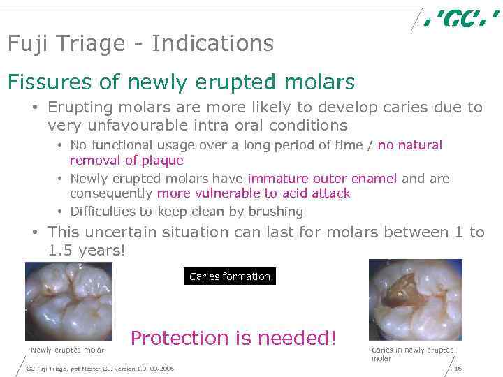 Fuji Triage - Indications Fissures of newly erupted molars • Erupting molars are more