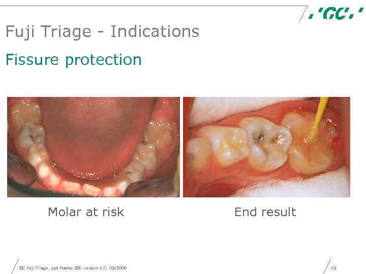 Fuji Triage - Indications Fissure protection Molar at risk GC Fuji Triage, ppt Master