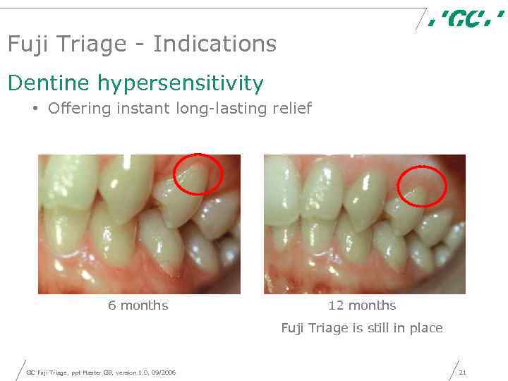 Fuji Triage - Indications Dentine hypersensitivity • Offering instant long-lasting relief 6 months 12