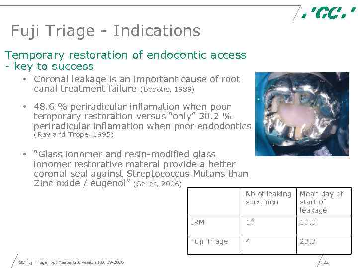  Fuji Triage - Indications Temporary restoration of endodontic access - key to success