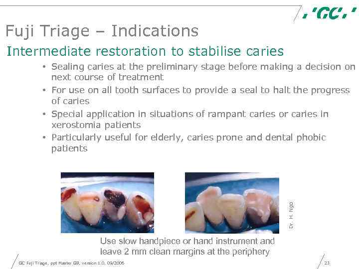 Fuji Triage – Indications Intermediate restoration to stabilise caries Dr. H. Ngo • Sealing