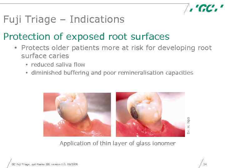 Fuji Triage – Indications Protection of exposed root surfaces • Protects older patients more