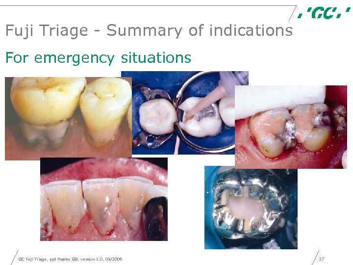 Fuji Triage - Summary of indications For emergency situations GC Fuji Triage, ppt Master