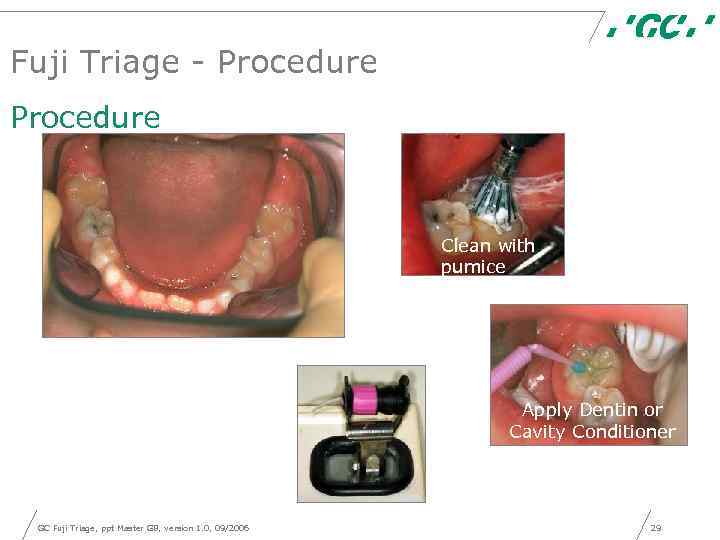 Fuji Triage - Procedure Clean with pumice Apply Dentin or Cavity Conditioner GC Fuji