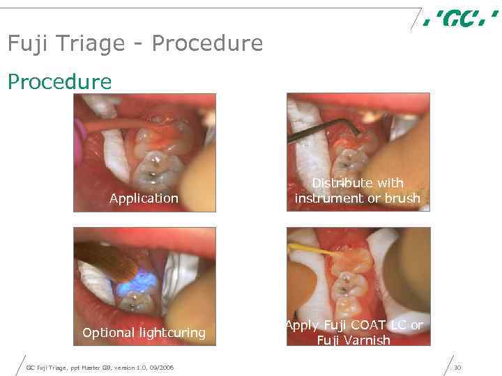 Fuji Triage - Procedure Application Fuji IX GP Fuji VII Optional lightcuring GC Fuji