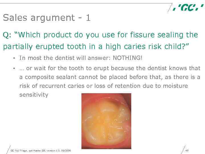 Sales argument - 1 Q: “Which product do you use for fissure sealing the