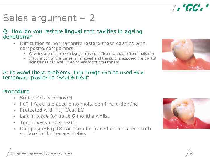 Sales argument – 2 Q: How do you restore lingual root cavities in ageing