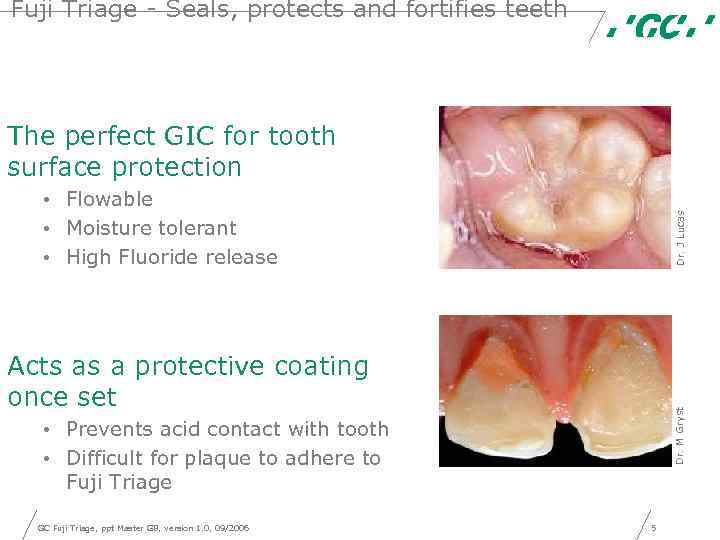 Fuji Triage - Seals, protects and fortifies teeth The perfect GIC for tooth surface