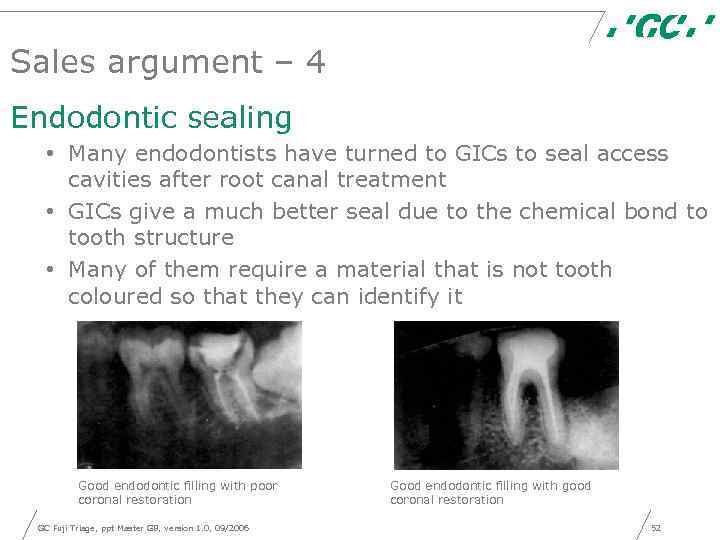 Sales argument – 4 Endodontic sealing • Many endodontists have turned to GICs to