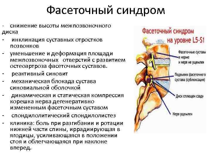 Фасеточный синдром - снижение высоты межпозвоночного диска - инклинация суставных отростков позвонков - уменьшение