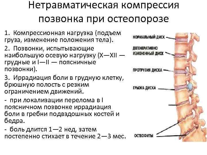 Нетравматическая компрессия позвонка при остеопорозе 1. Компрессионная нагрузка (подъем груза, изменение положения тела). 2.