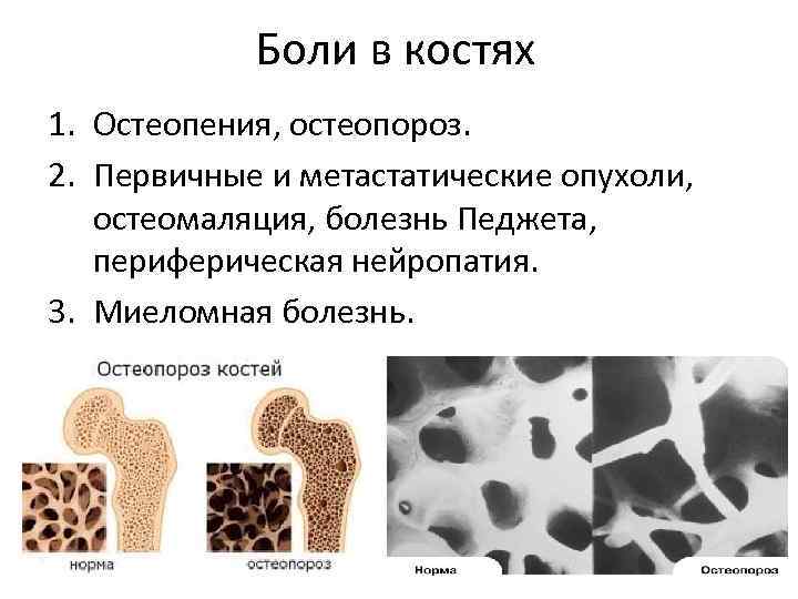 Боли в костях 1. Остеопения, остеопороз. 2. Первичные и метастатические опухоли, остеомаляция, болезнь Педжета,