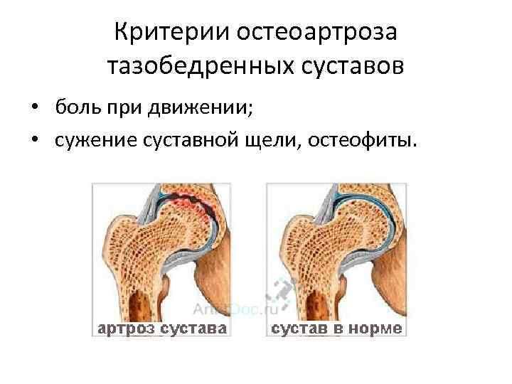 Критерии остеоартроза тазобедренных суставов • боль при движении; • сужение суставной щели, остеофиты. 