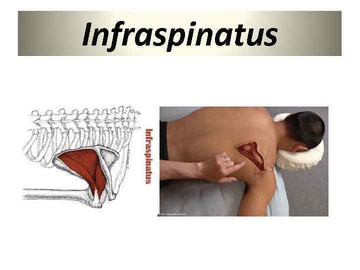 Infraspinatus 