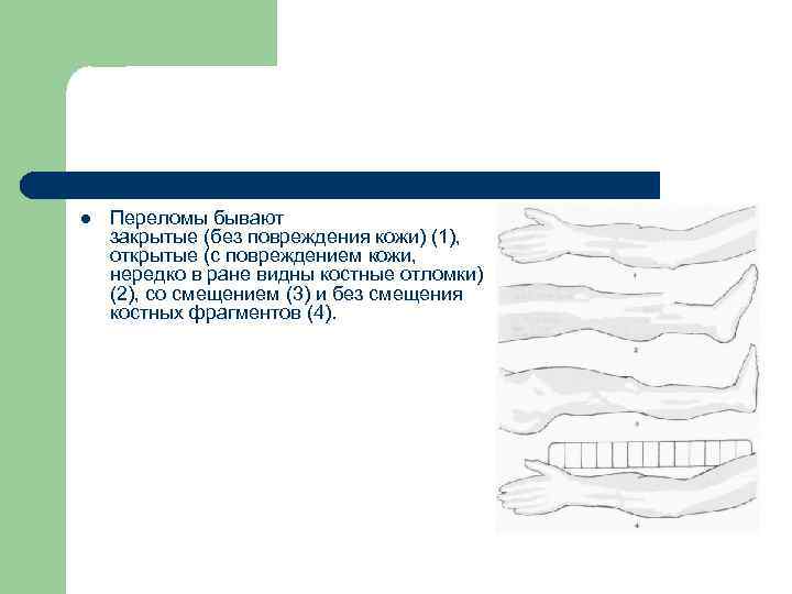 l Переломы бывают закрытые (без повреждения кожи) (1), открытые (с повреждением кожи, нередко в