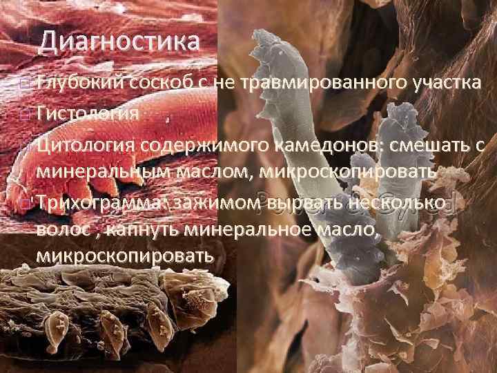 Диагностика Глубокий соскоб с не травмированного участка Гистология Цитология содержимого камедонов: смешать с минеральным