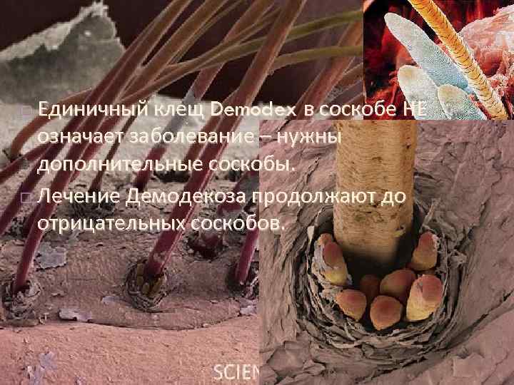 Единичный клещ Demodex в соскобе НЕ означает заболевание – нужны дополнительные соскобы. Лечение Демодекоза