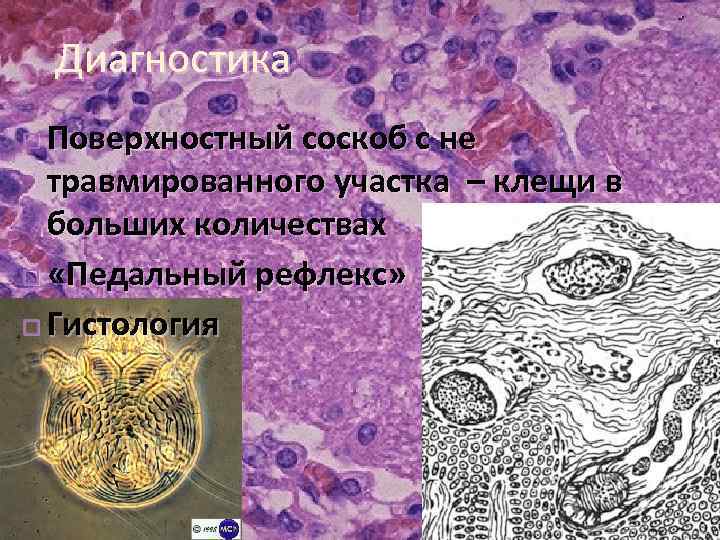 Диагностика Поверхностный соскоб с не травмированного участка – клещи в больших количествах «Педальный рефлекс»