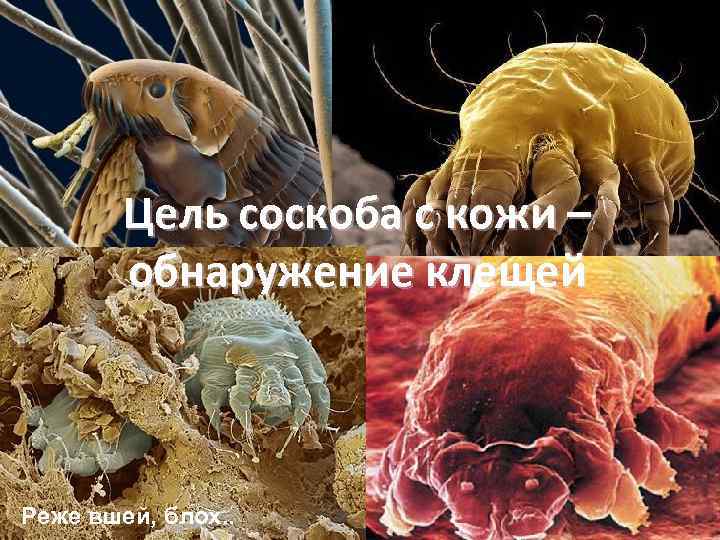 Цель соскоба с кожи – обнаружение клещей Реже вшей, блох. . 