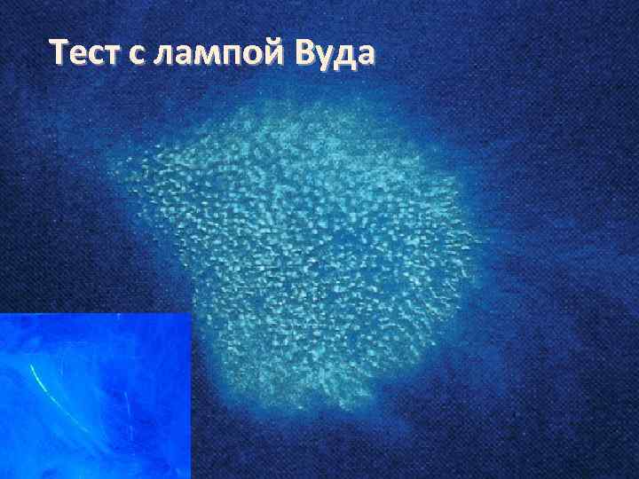 Тест с лампой Вуда 