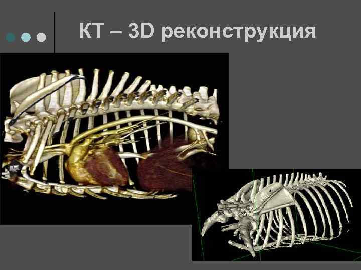 КТ – 3 D реконструкция 