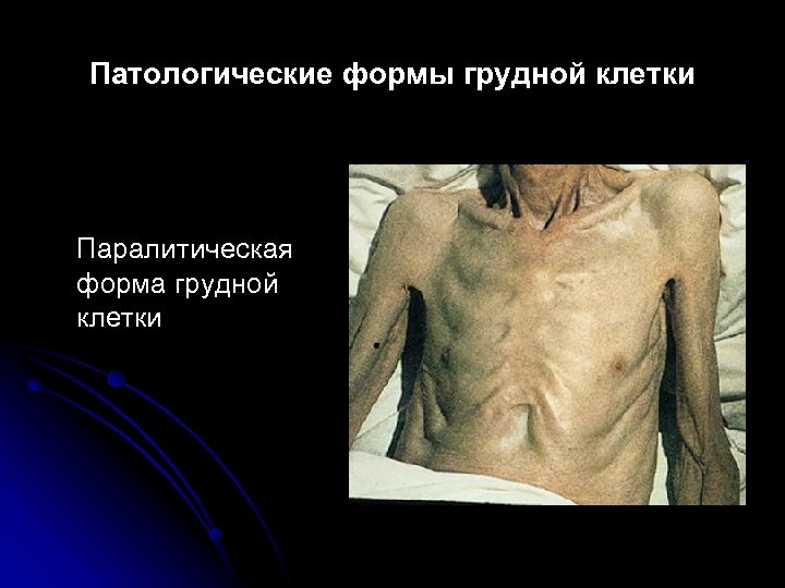 Патологические формы грудной клетки Паралитическая форма грудной клетки 