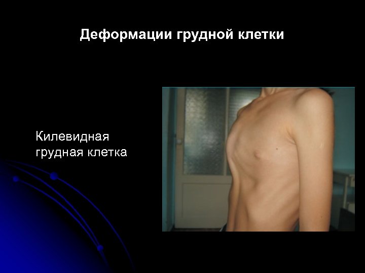 Деформации грудной клетки Килевидная грудная клетка 