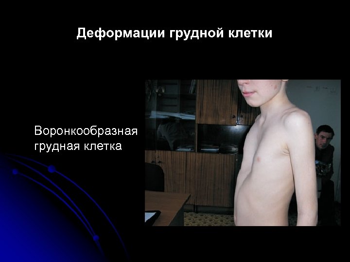 Деформации грудной клетки Воронкообразная грудная клетка 