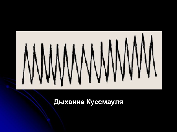 Дыхание Куссмауля 
