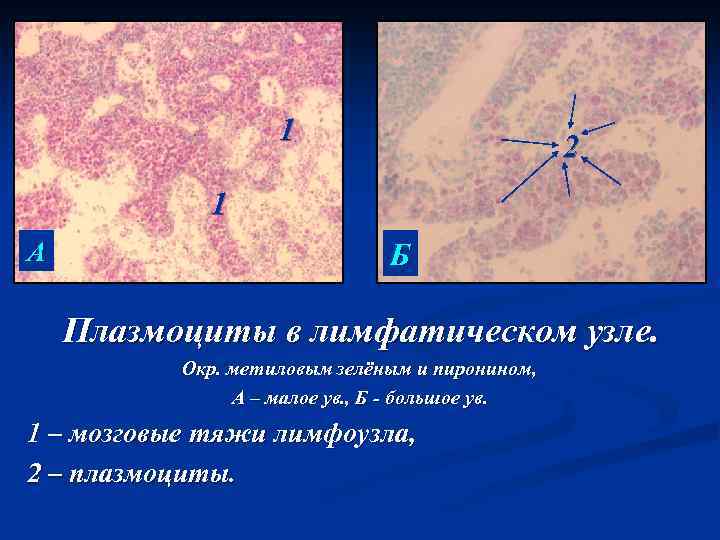 1 2 1 А Б Плазмоциты в лимфатическом узле. Окр. метиловым зелёным и пиронином,