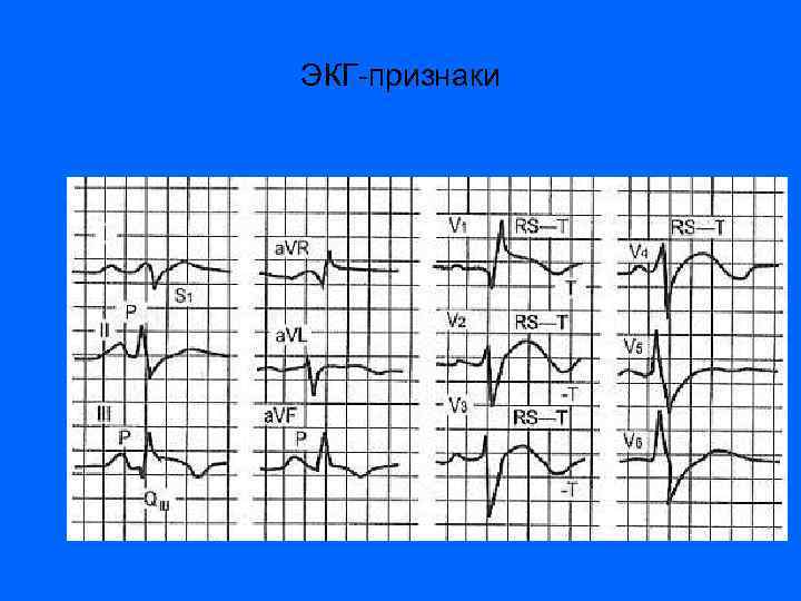 ЭКГ-признаки 