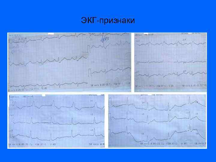 ЭКГ-признаки 