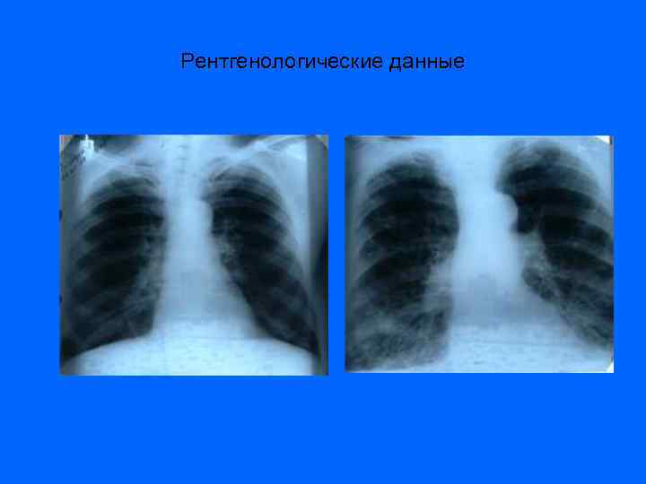 Рентгенологические данные 