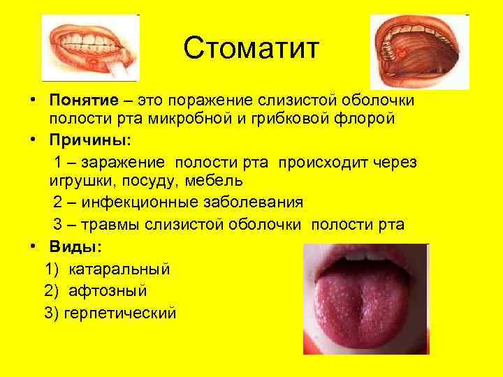 Стоматит • Понятие – это поражение слизистой оболочки полости рта микробной и грибковой флорой